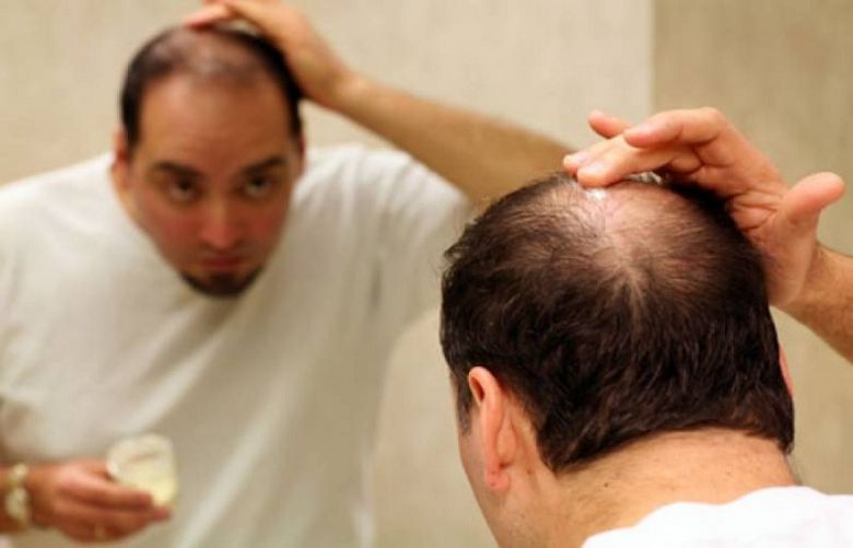 Hair loss linked with defective immune cells