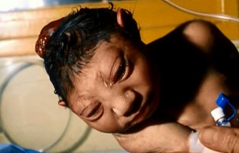 An infant born with severe deformities in Fallujah Iraq, allegedly due to the heavy use of depleted uranium by US forces