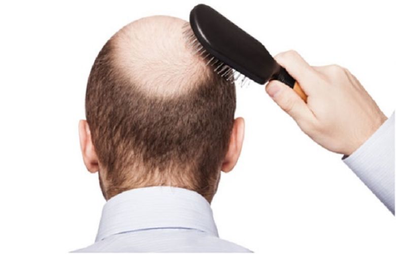 Good News For Hair Fall Persons Even Men And Women