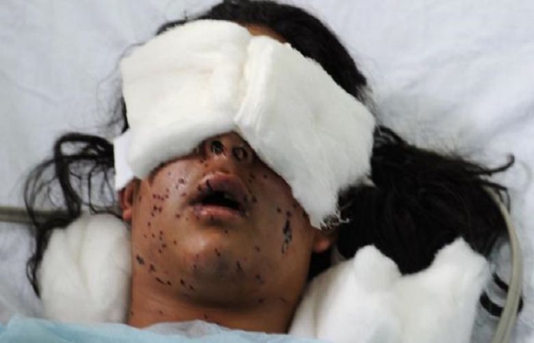 Indian military is inflicting blinding as collective punishment on Kashmiris