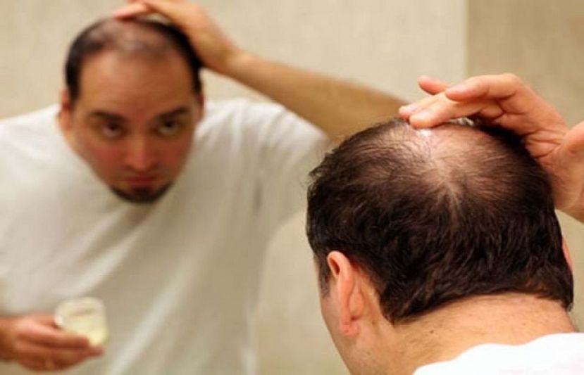 مردوں کے بال کیسے اور کیوں گرتے ہیں؟ تمام باتیں جو آپ جاننا چاہتے ہیں