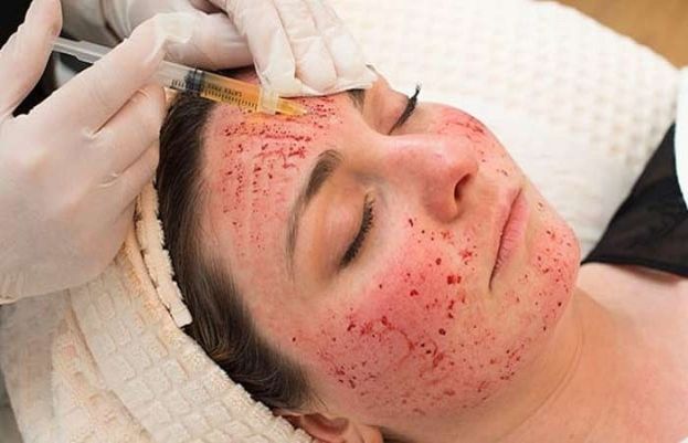 Three infected with HIV after getting &#039;vampire facials&#039; in New Mexico