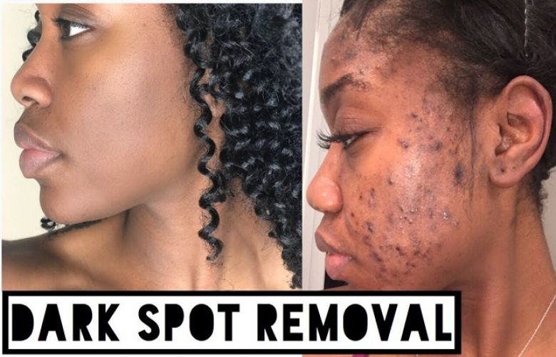 People with black skin can be prone to dark spots