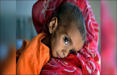 Millions of malnourished in Pakistan despite abundance of food