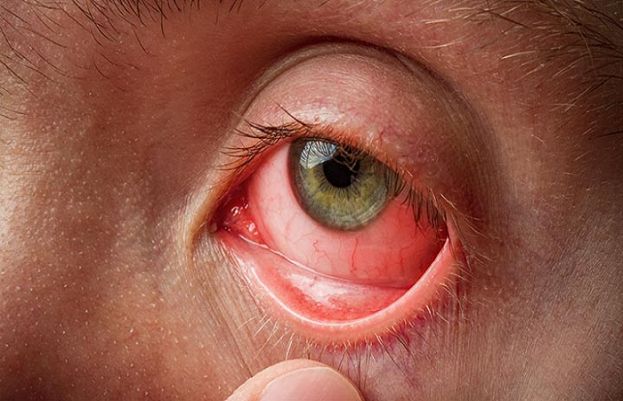 Pink eye infection