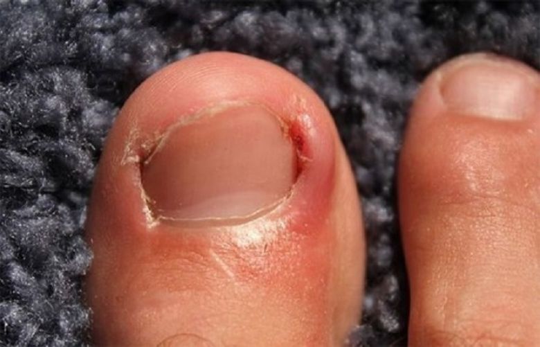 Ingrown Toenail: Remedies, When to See Your Doctor