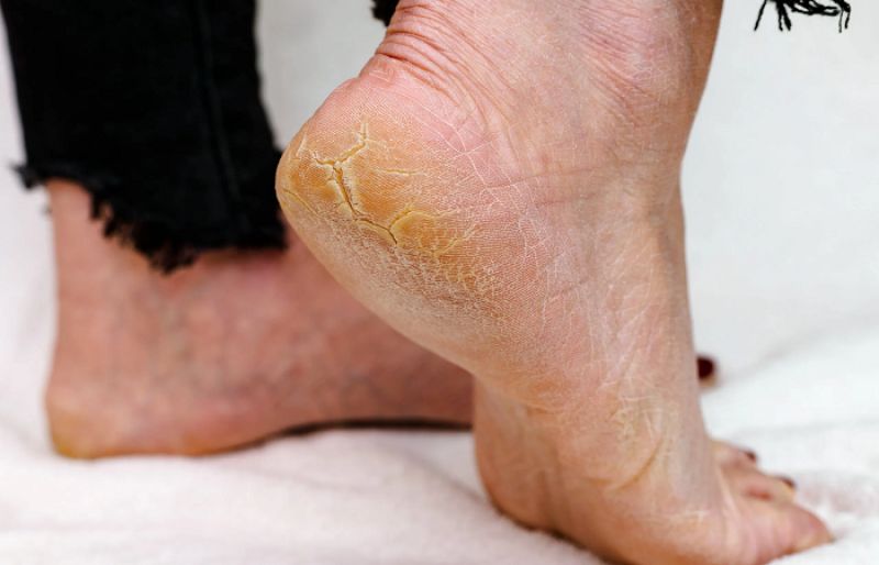 How to Get Rid of Dry Skin on Your Feet – SUCH TV