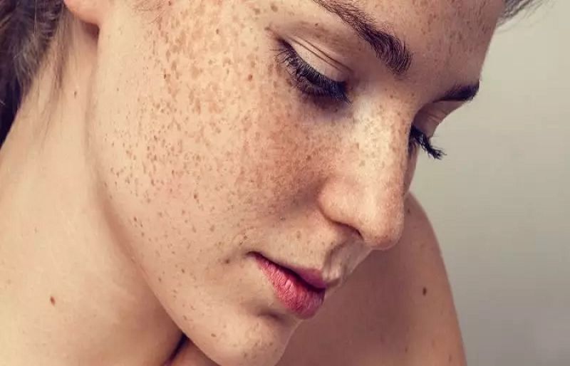 Ways How People Can Get Rid of Freckles – SUCH TV