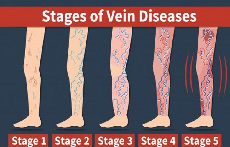 Do compression stockings help to treat varicose veins?