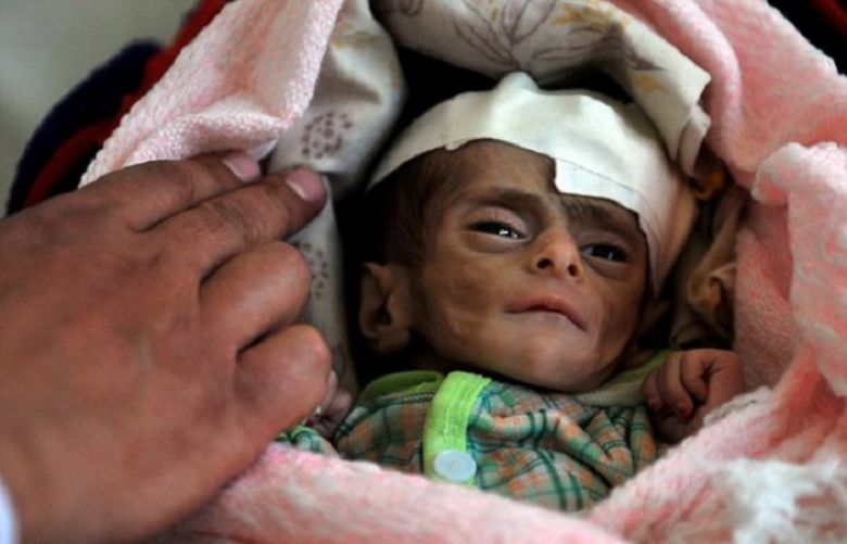 The Starving Children of Yemen
