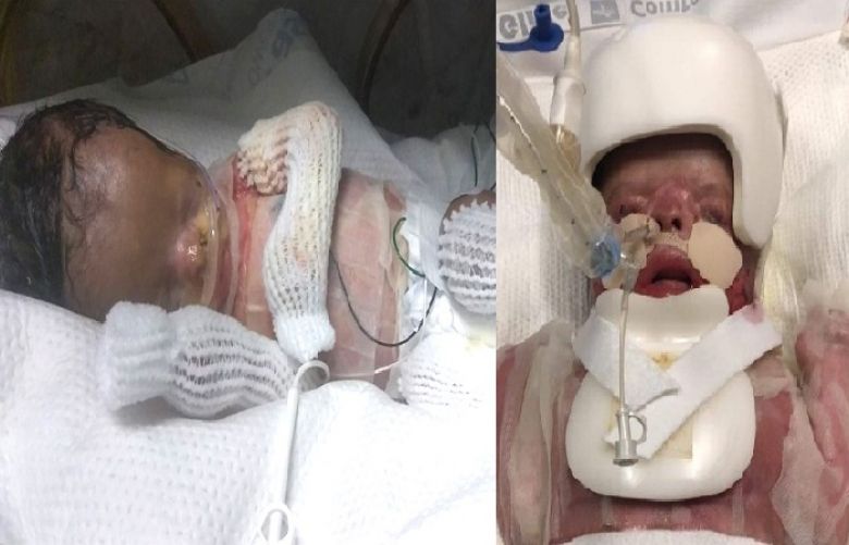 The baby boy has been healing well since skin grafts were applied to his body.