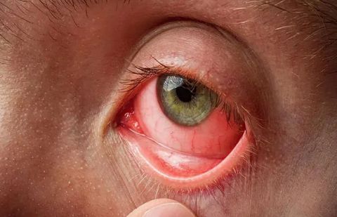 More than 9,000 cases of pink eye infection reported in Punjab
