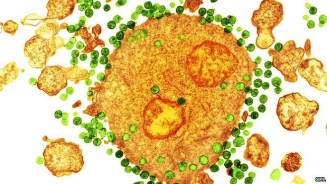 HIV budding out of a T-cell, part of the immune system.