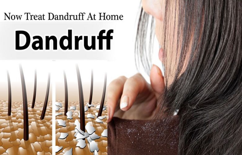 Remedies To Treat Dandruff At Home