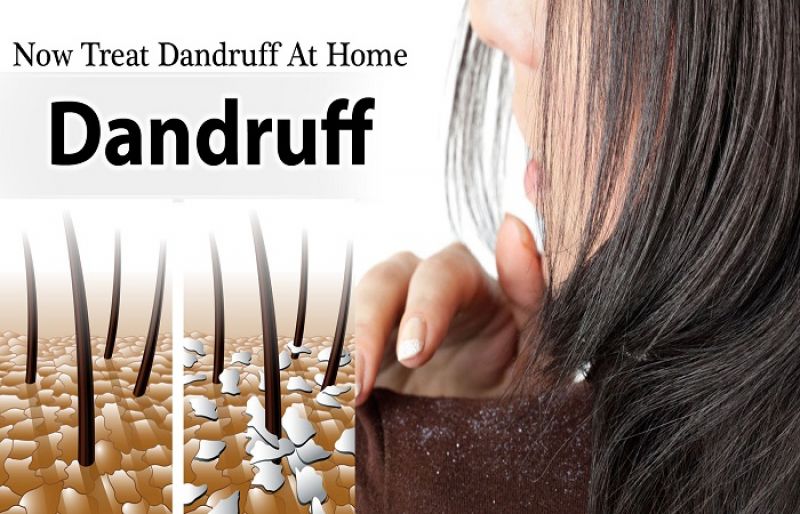 10 Home Remedies To Treat Dandruff At Home - SUCH TV