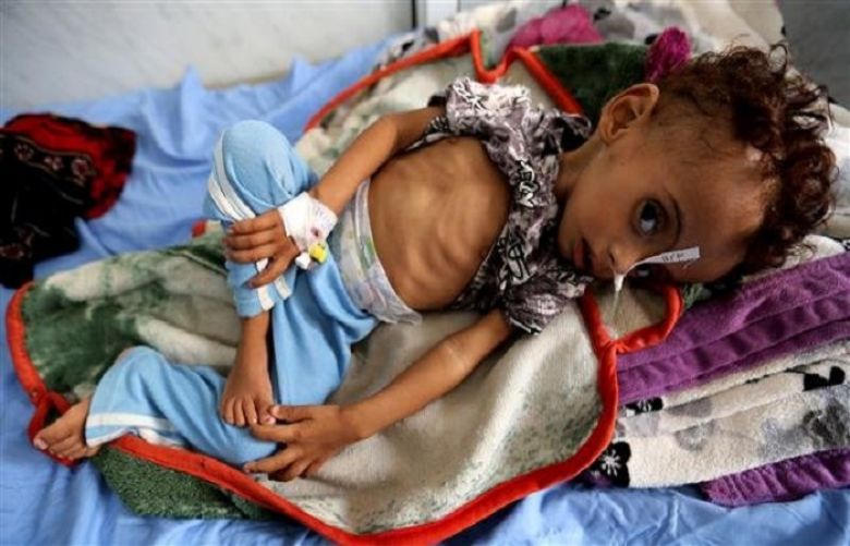A malnourished Yemeni child lies on a bed at a malnutrition treatment ward at al-Thawra hospital in Hudaydah, Yemen, November 3, 2018. 