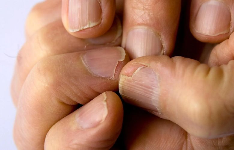 How to treat cracked nails