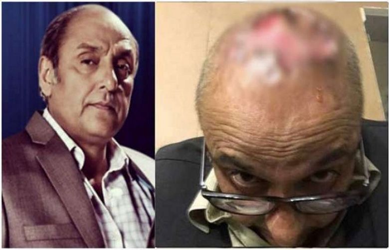 Pakistani actor Sajid Hasan&#039;s hair transplant goes wrong