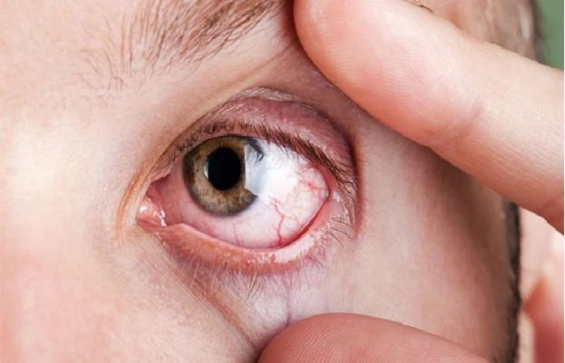 5 untrue chronic dry eye 'facts'