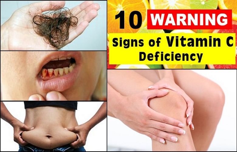 Do you know symptoms of vitamin C deficiency?