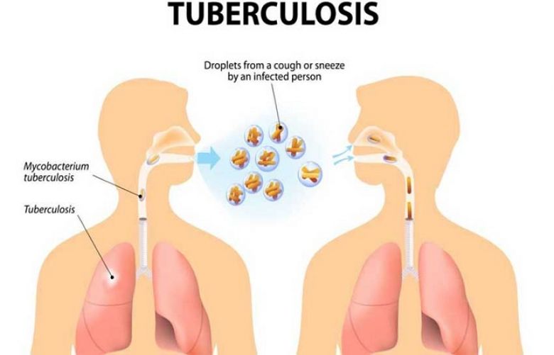 KP Govt launch 2nd phase special program to eradicate tuberculosis