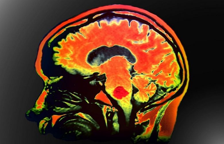 Immunotherapy Drugs Slow Skin Cancer That Has Spread to the Brain