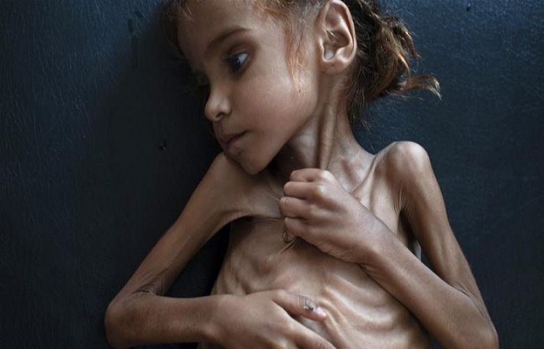 Amal Hussain died of malnutrition in a refugee camp in northern Yemen. She was seven years old