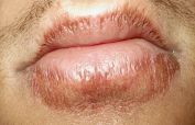 Are some foods bad for my lips?