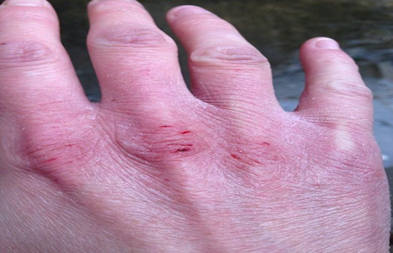 Why does the skin on my knuckles crack and bleed in winter?