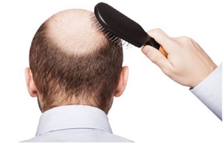 New genetic culprit found for early progressive hair loss