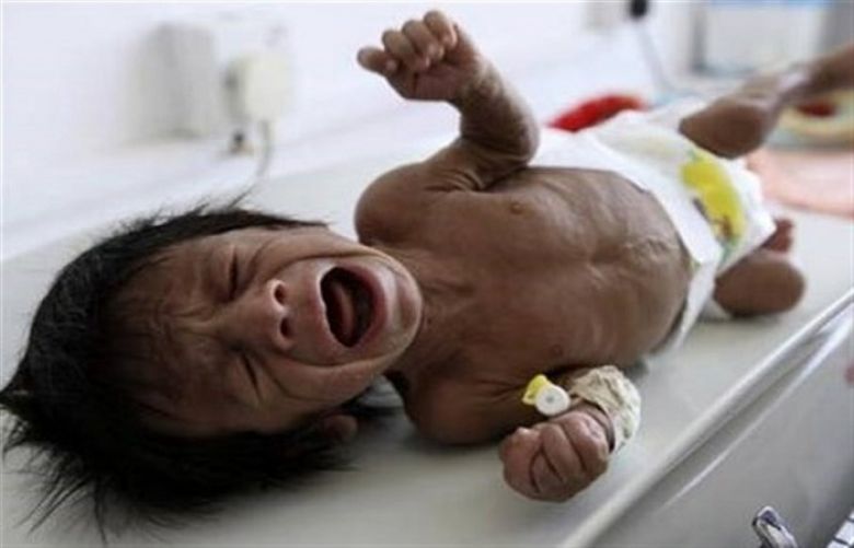 Yemen: Children in Hudaydah hospital at imminent risk of death
