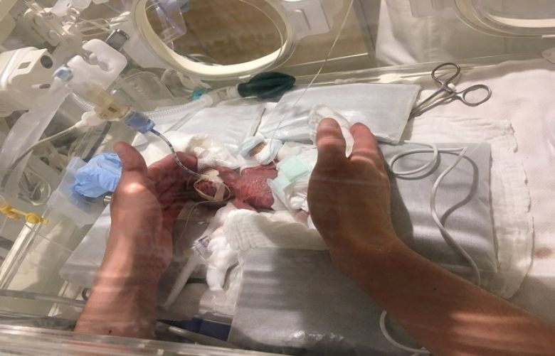 A baby boy weighing 268 grams is seen five days after his birth in Tokyo, Japan. 