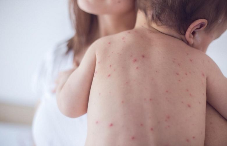 Measles cases triple globally in 2019: WHO