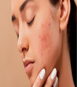 7 Powerful home remedies for acne