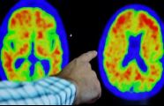 People with two copies of a risk gene have genetic form of Alzheimer’s, say scientists