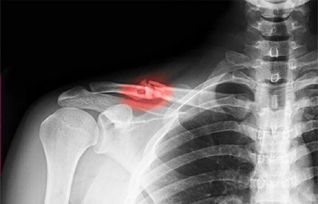 پیچیدہ فریکچرکے بعد ہڈی کی بحالی اب آسان