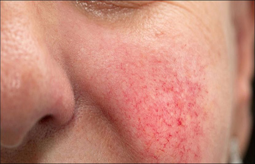 ماہرین کے مطابق کچھ فیشلز جلد کو سنوارنے کے بجائے نقصان پہنچا سکتے ہیں