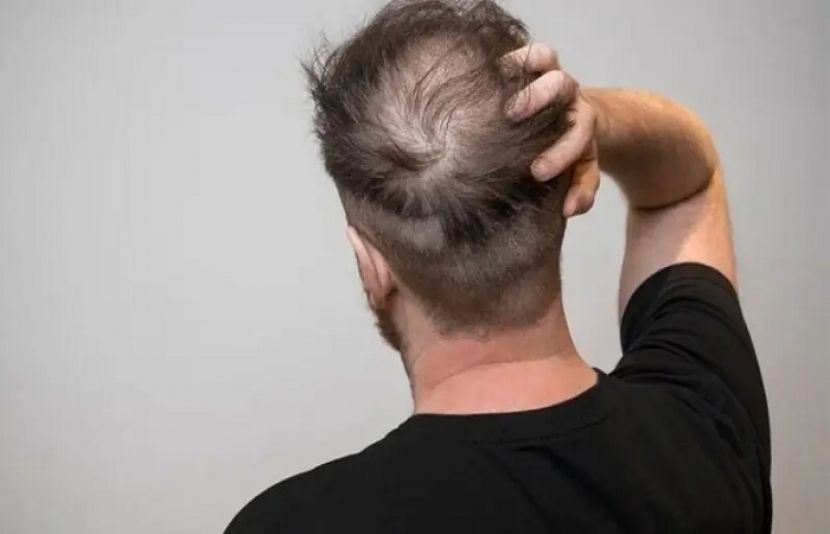 زیادہ میٹھے مشروبات پینے سے بال جھڑنے کے خطرے میں اضافہ ہو سکتا ہے