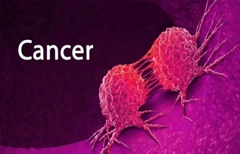 پھیپڑوں کا کینسر دنیا میں سرطان کی سب سے زیادہ عام قسم ہے