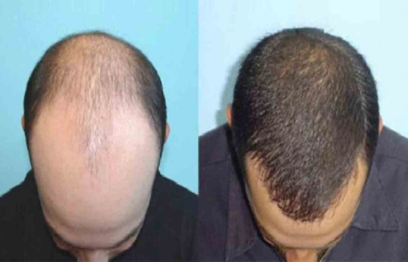 صدر نے گنج پن کو ملک کیلئے سنگین مسئلہ قرار دیا