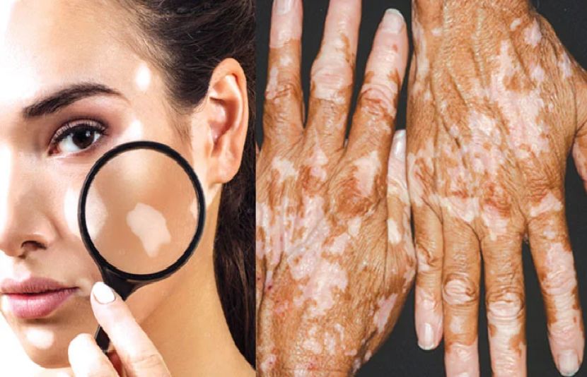 جلدی بیماری برص