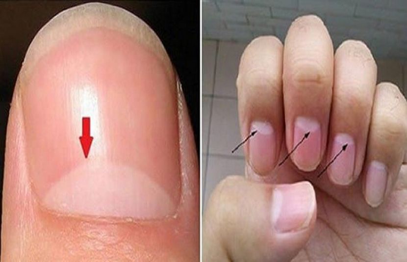 اس نشان کو طبی زبان میں &#039;لونیولا&#039; کہا جاتا ہے