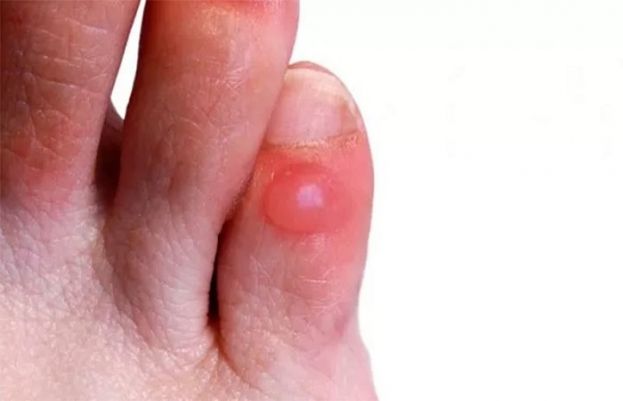 سیال سے بھرا چھالہ 