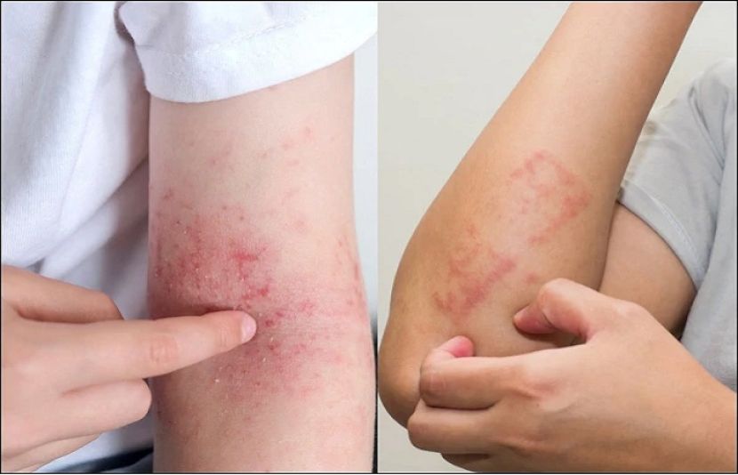 سردیوں کی خارش