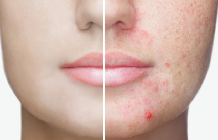 کیل مہاسوں سے مکمل نجات کا آسان نسخہ