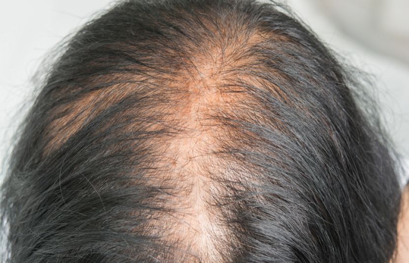 جانیے چند طریقے جوصحت مند بالوں کو پتلا ہونے سے بچائیں
