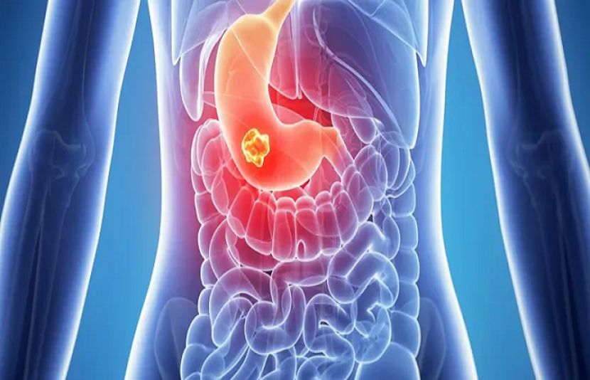 معدے کے درد کا گھریلو علاج، بغیر دوا کے آرام