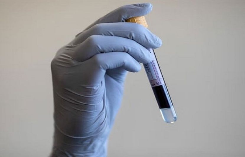 ایک ایسا خون کا ٹیسٹ جو دل کے دورے کا خطرہ کم کرے