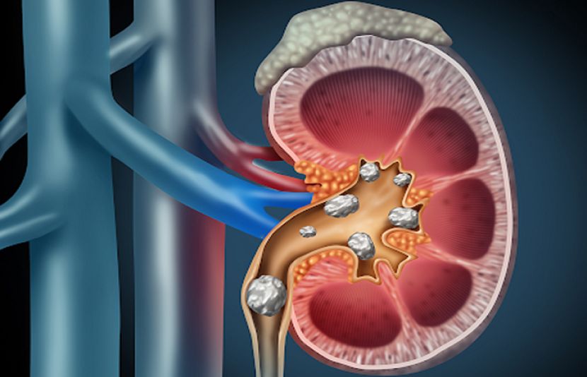 میٹھی غذاؤں اور میٹھے مشروبوں کا زیادہ استعمال گردے میں پتھری کا سبب بن سکتے ہیں۔