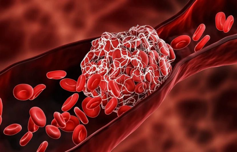 خون جم جانے والا مرض